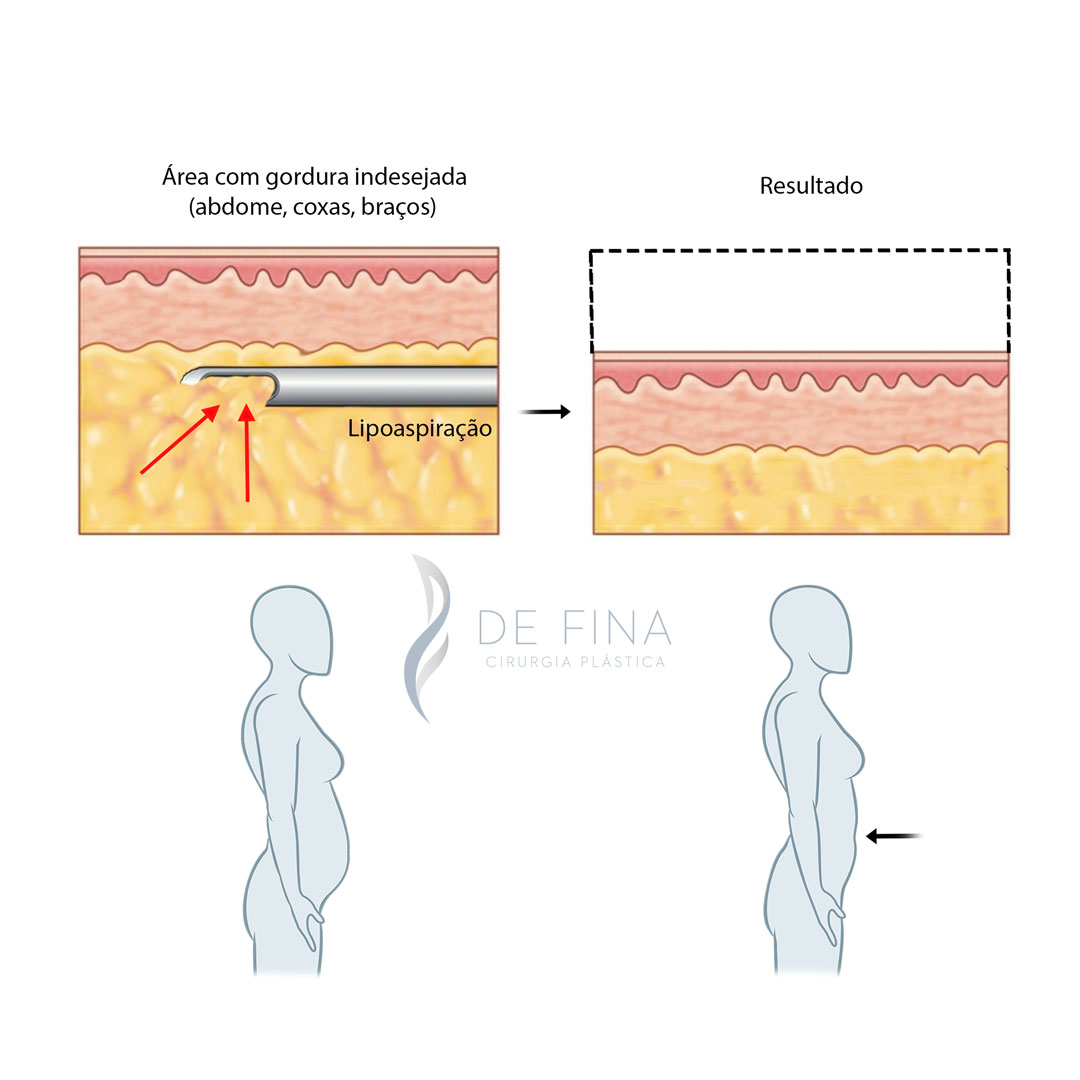 Esquema pré e pós de lipoaspiração