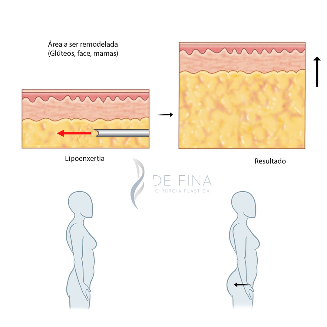 Esquema de lipoenxertia pré e pós