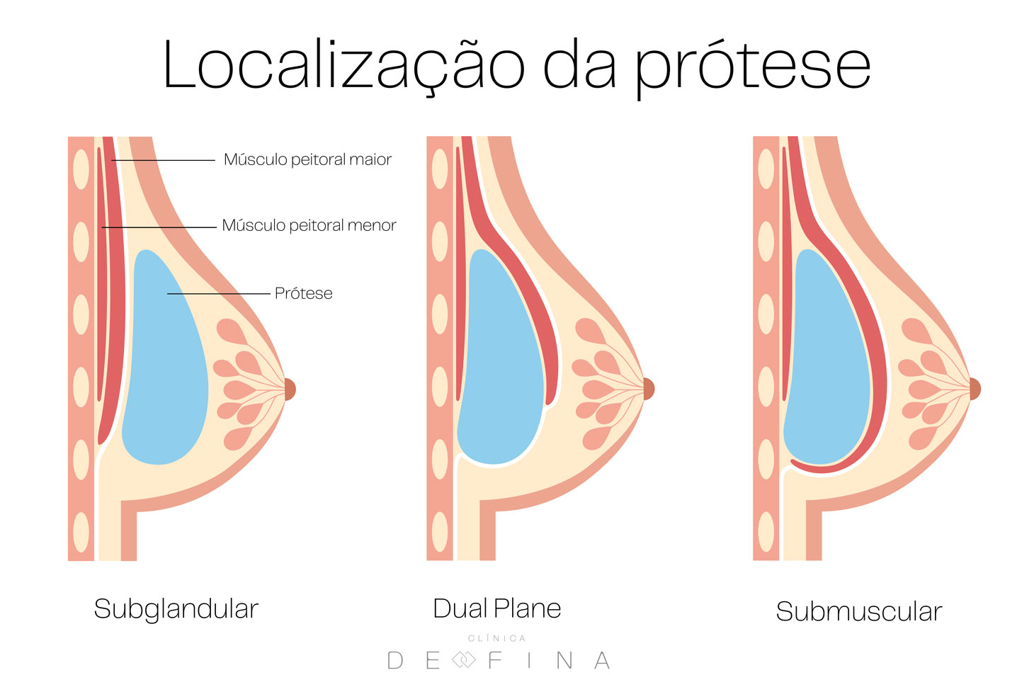 Esquematização posição da prótese