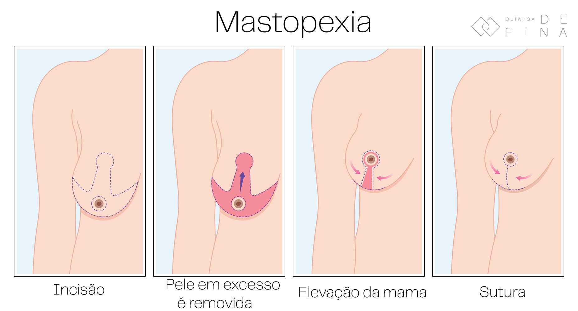 Esquematização mastopexia