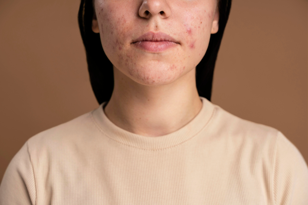 Rosto de uma pessoa jovem com acne visível na região das bochechas, queixo e ao redor da boca.