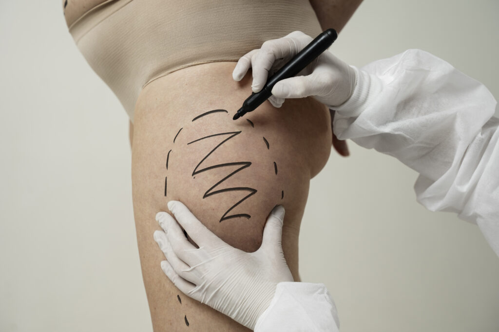 Profissional da saúde, usando luvas brancas, faz marcações com caneta preta na coxa de uma paciente para procedimento estético ou cirúrgico.