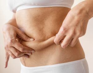 Abdominoplastia