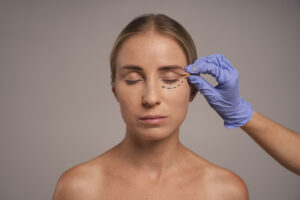 Mulher com marcas cirúrgicas na pálpebra para blefaroplastia, enquanto uma mão enluvada segura a pele próxima ao olho