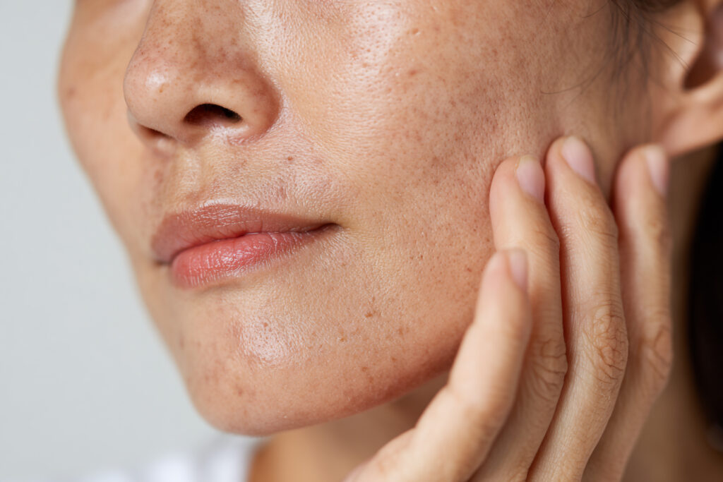 Rosto feminino em close, com manchas escuras características de melasma nas bochechas e maçãs do rosto.