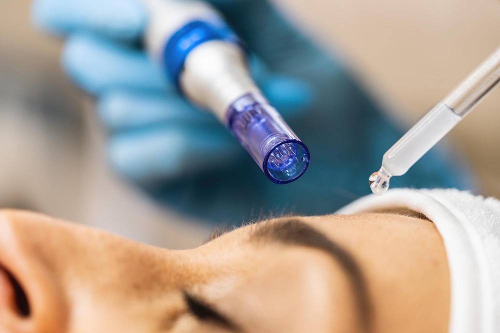 Tratamento facial com microagulhamento e aplicação de sérum.