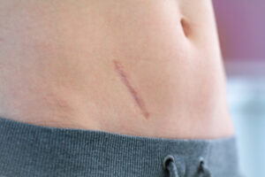 Close da região abdominal de uma pessoa com pequena cicatriz linear visível próxima ao lado do abdômen.
