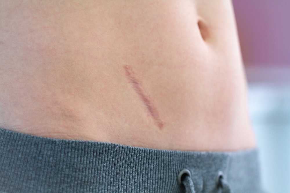 Close da região abdominal de uma pessoa com pequena cicatriz linear visível próxima ao lado do abdômen.