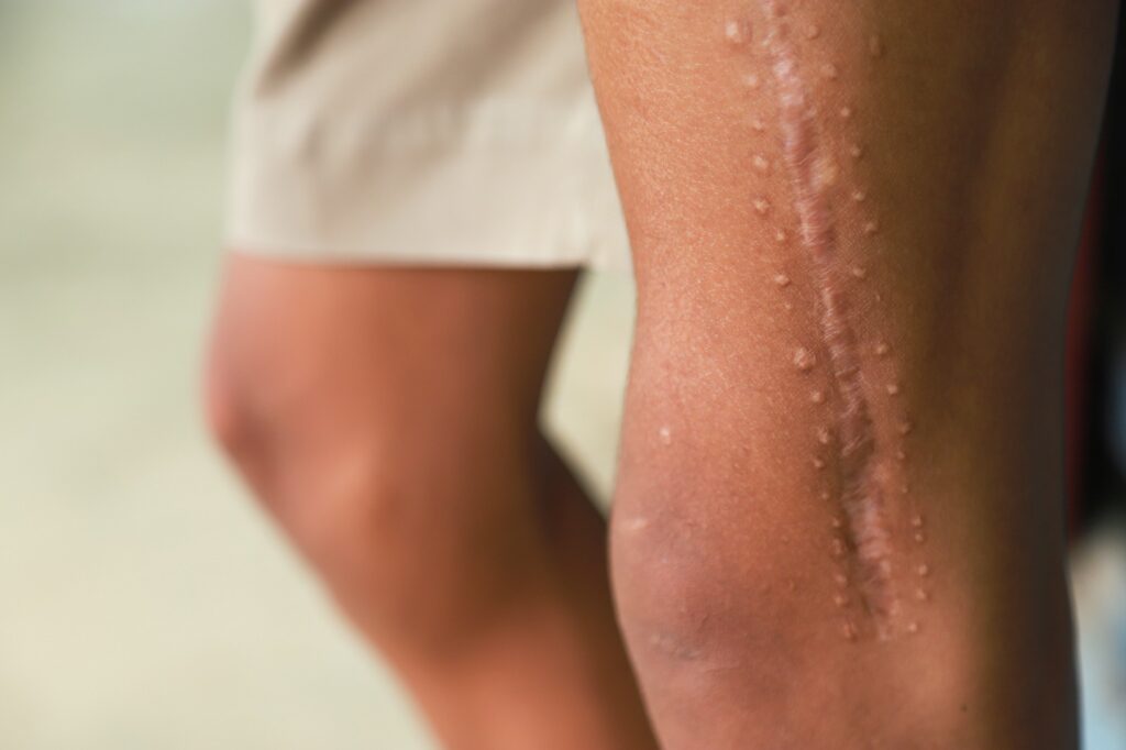 Quando a cicatrização atrapalha: entenda a fibrose patológica